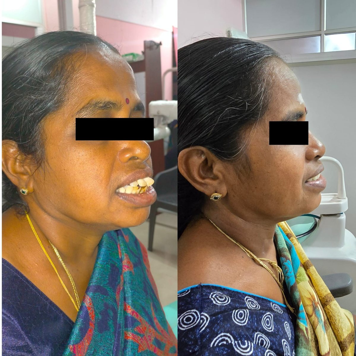 Smile Makeover Treatment — before and after, patient 5