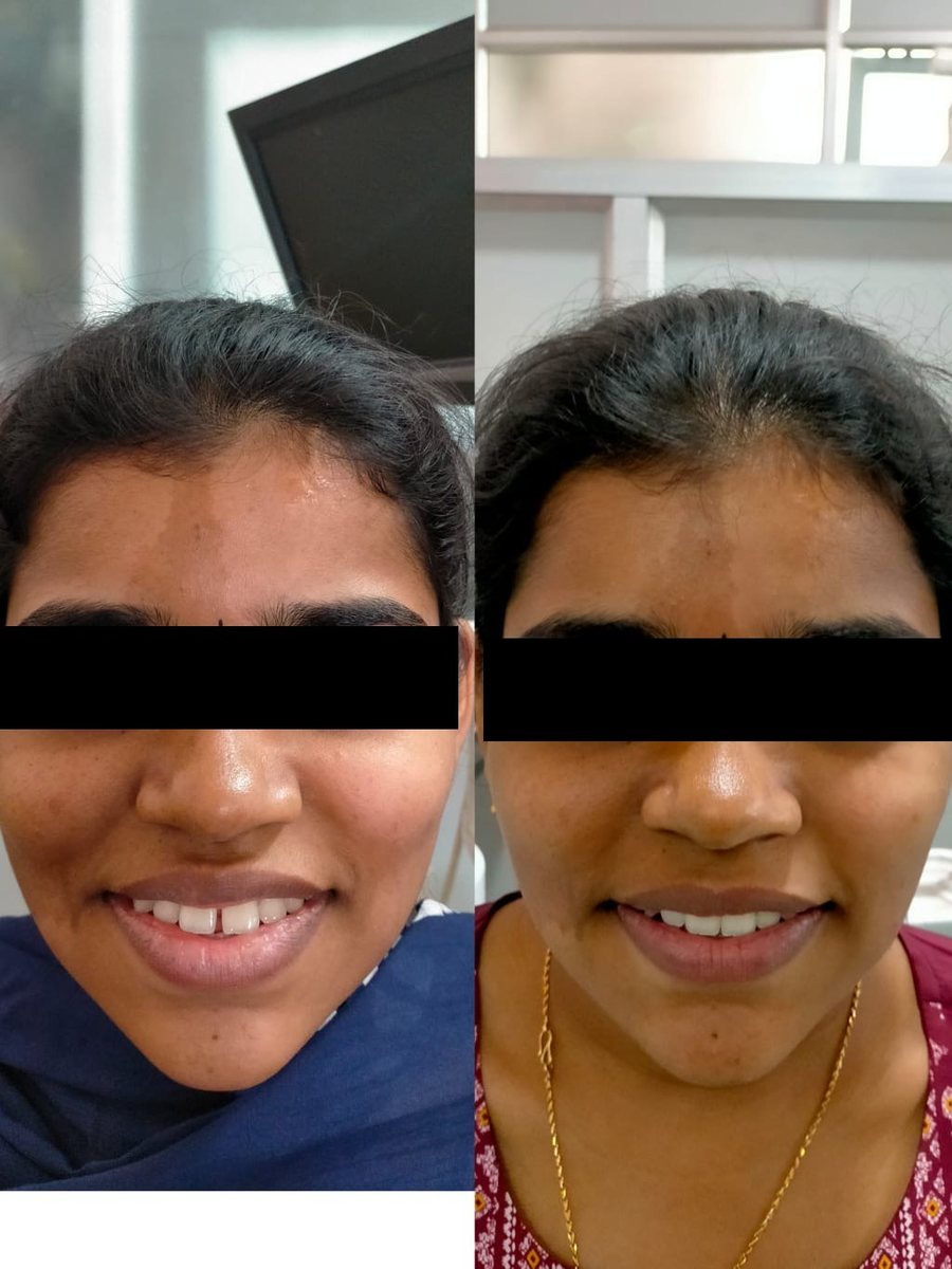 Smile Makeover Treatment — before and after, patient 6