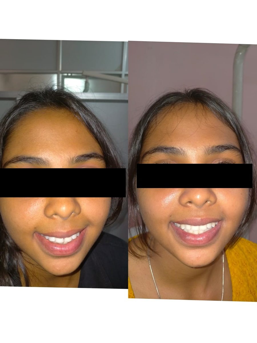 Smile Makeover Treatment — before and after, patient 7