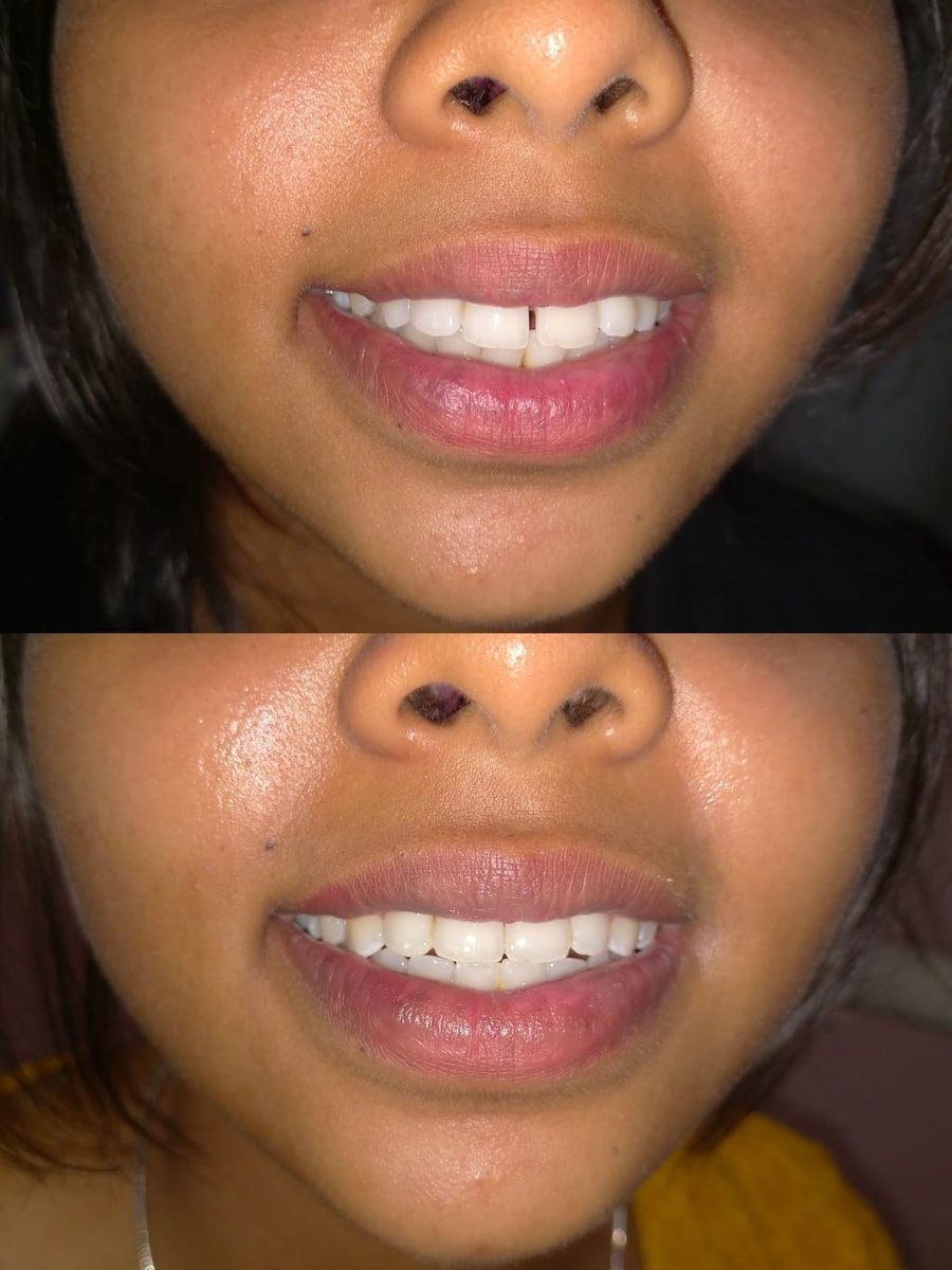 Smile Makeover Treatment — before and after, patient 8
