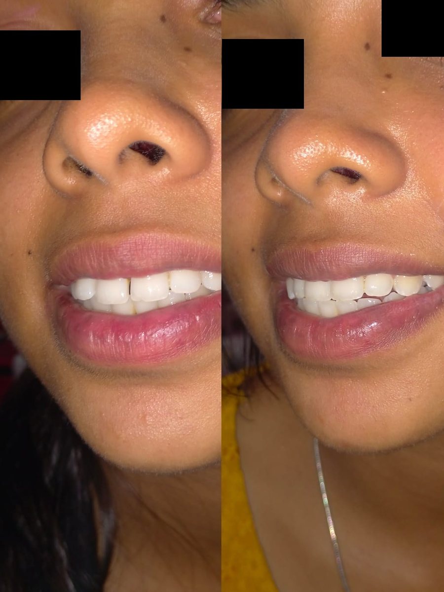 Smile Makeover Treatment — before and after, patient 9