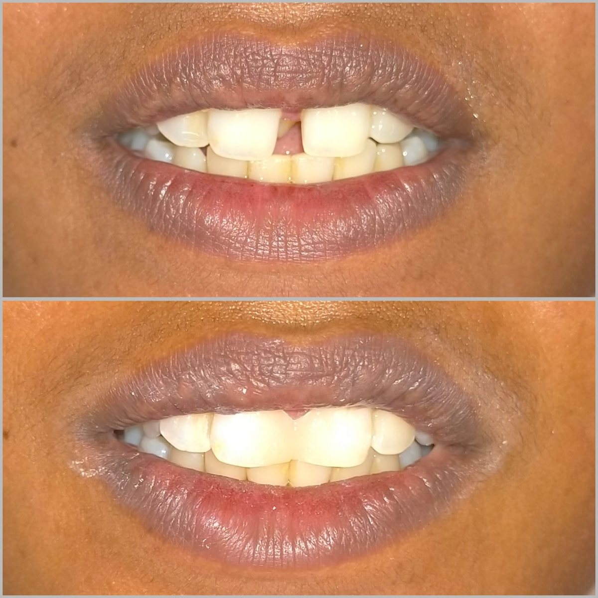 Smile Makeover with Composite Filling — before and after, patient 1