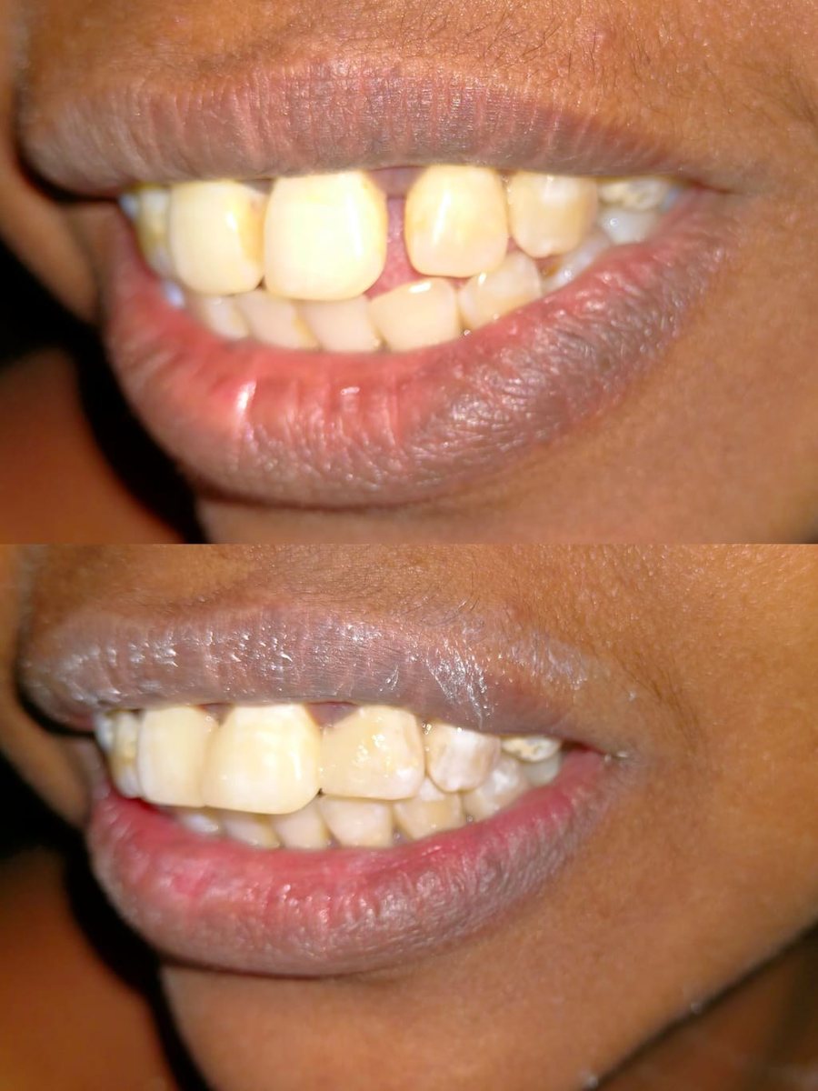 Smile Makeover with Composite Filling — before and after, patient 10
