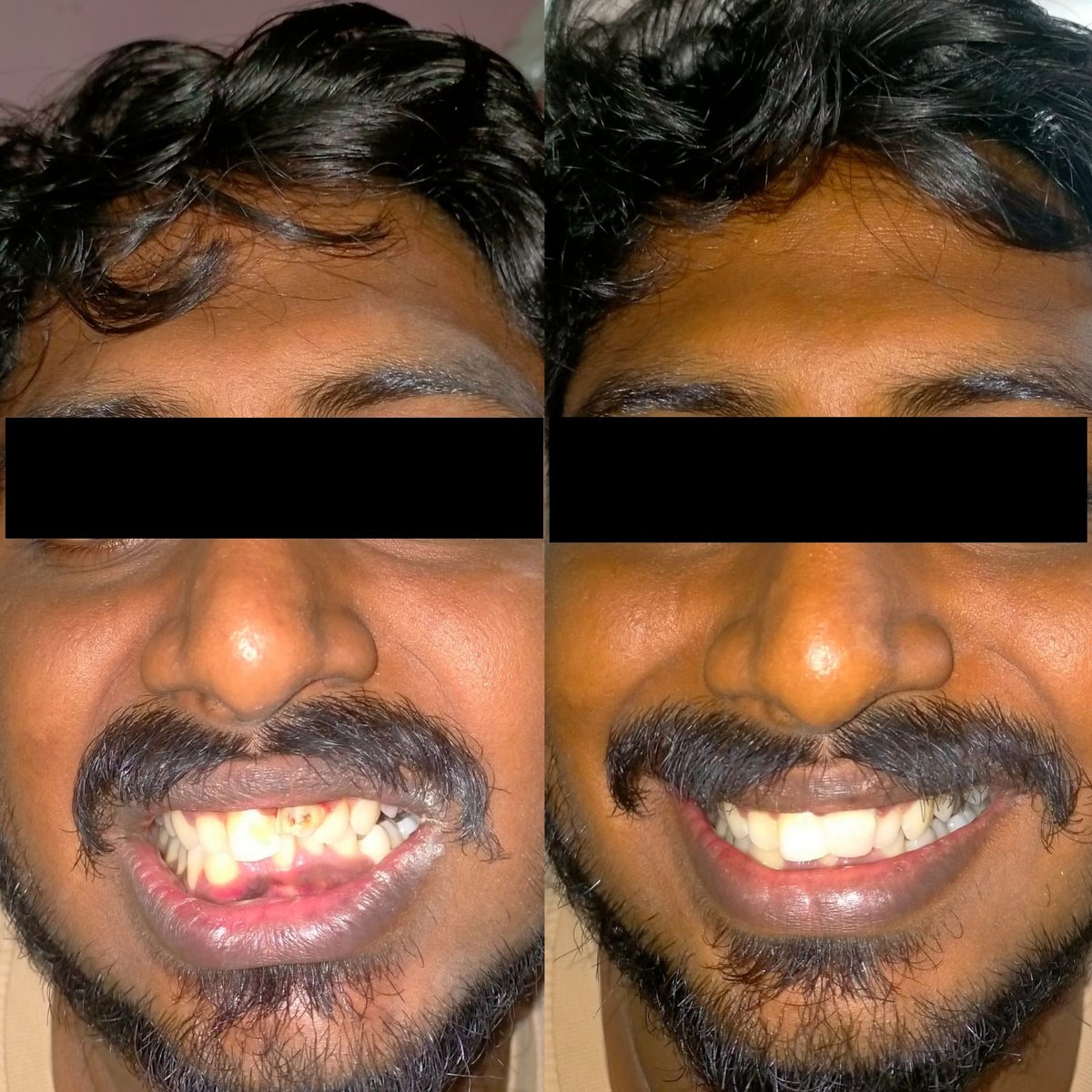 Smile Makeover with Composite Filling — before and after, patient 11