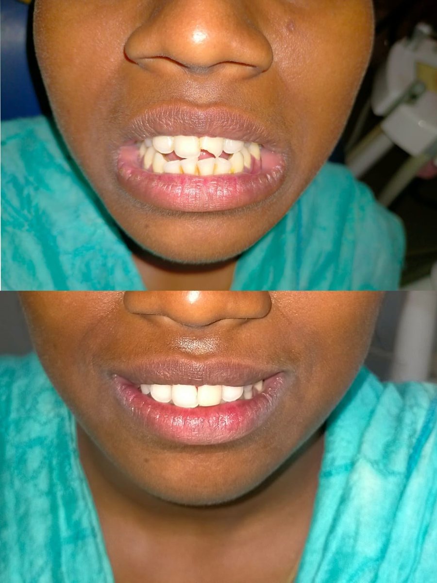 Smile Makeover with Composite Filling — before and after, patient 12