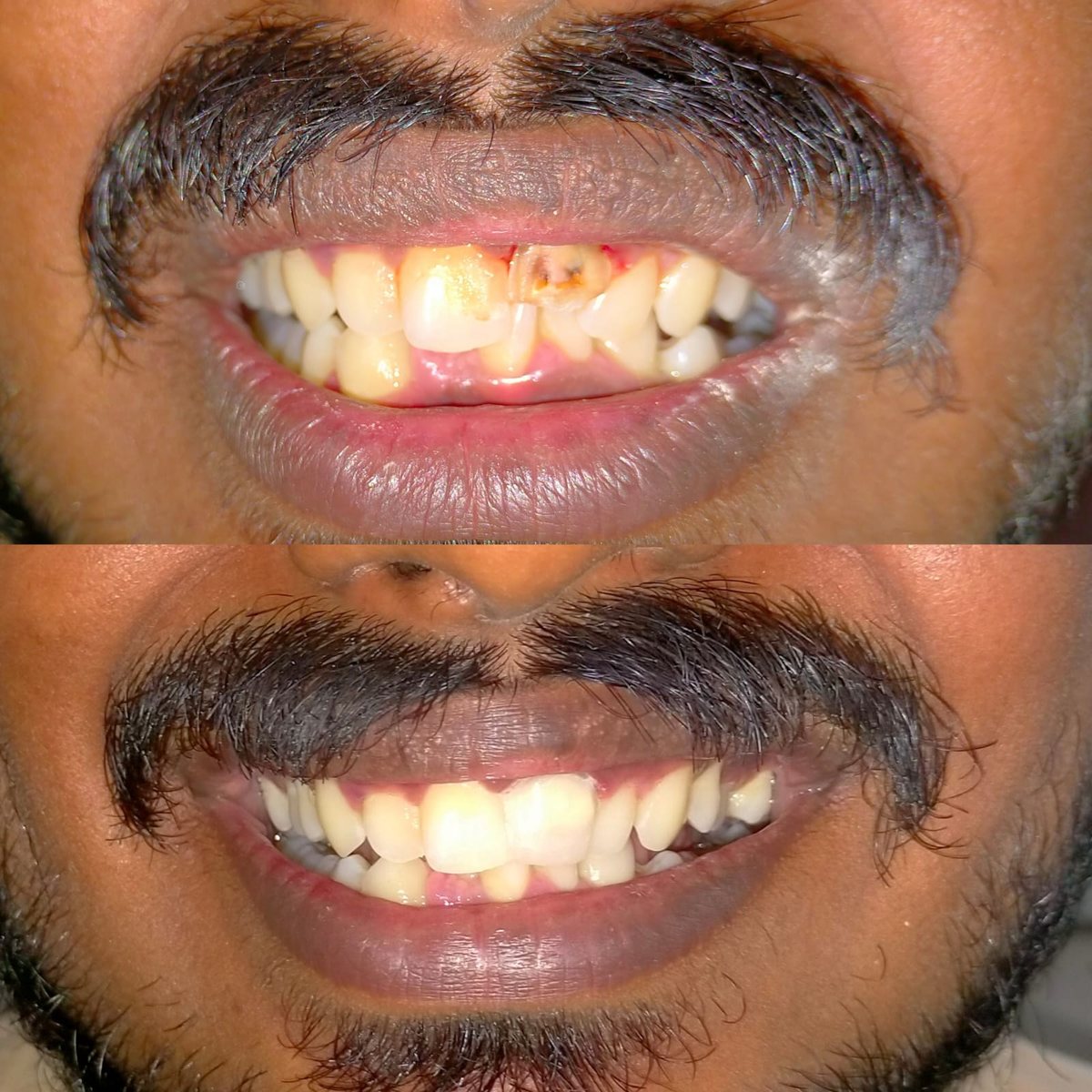 Smile Makeover with Composite Filling — before and after, patient 13