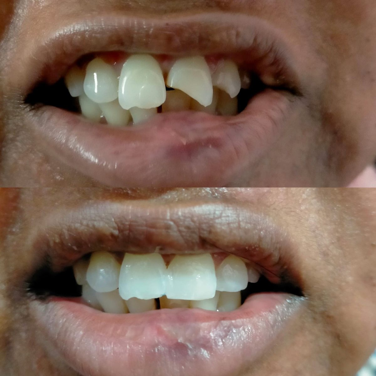 Smile Makeover with Composite Filling — before and after, patient 14