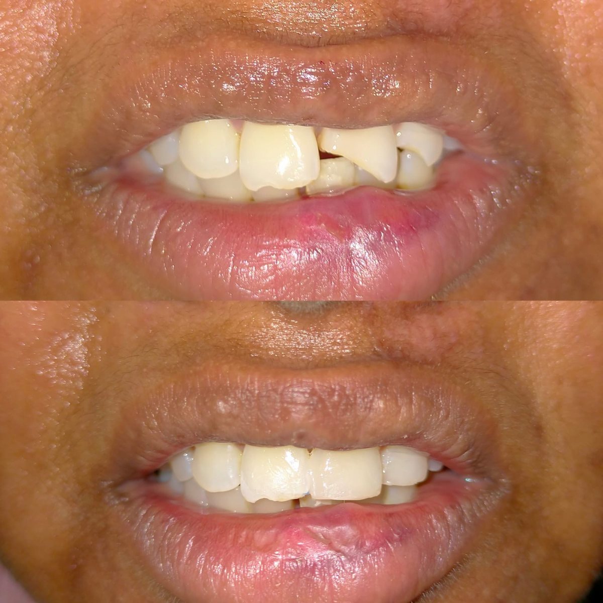 Smile Makeover with Composite Filling — before and after, patient 15