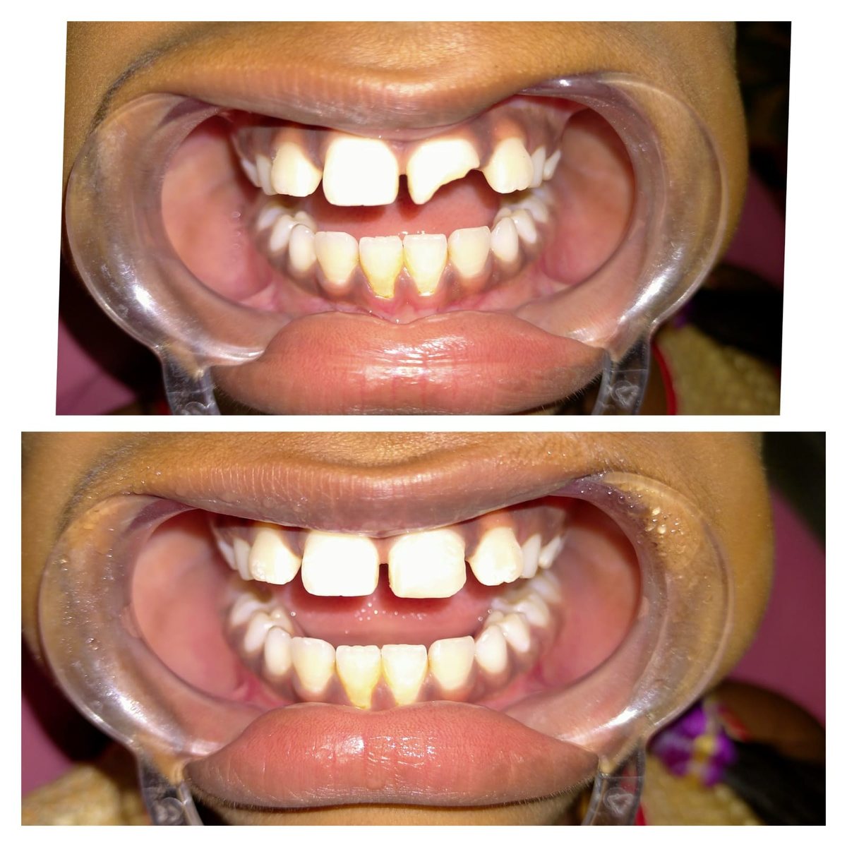 Smile Makeover with Composite Filling — before and after, patient 2