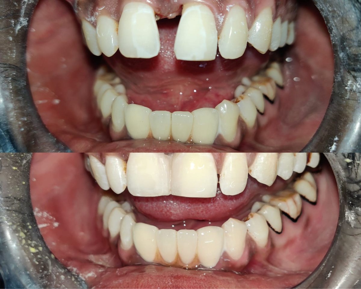 Smile Makeover with Composite Filling — before and after, patient 3
