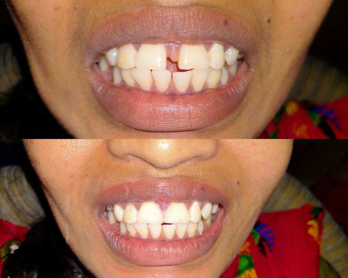 Smile Makeover with Composite Filling — before and after, patient 4
