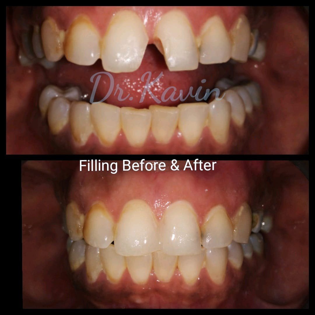 Smile Makeover with Composite Filling — before and after, patient 5