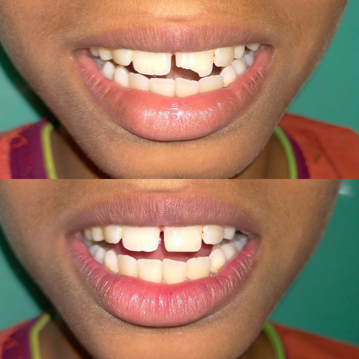 Smile Makeover with Composite Filling — before and after, patient 6