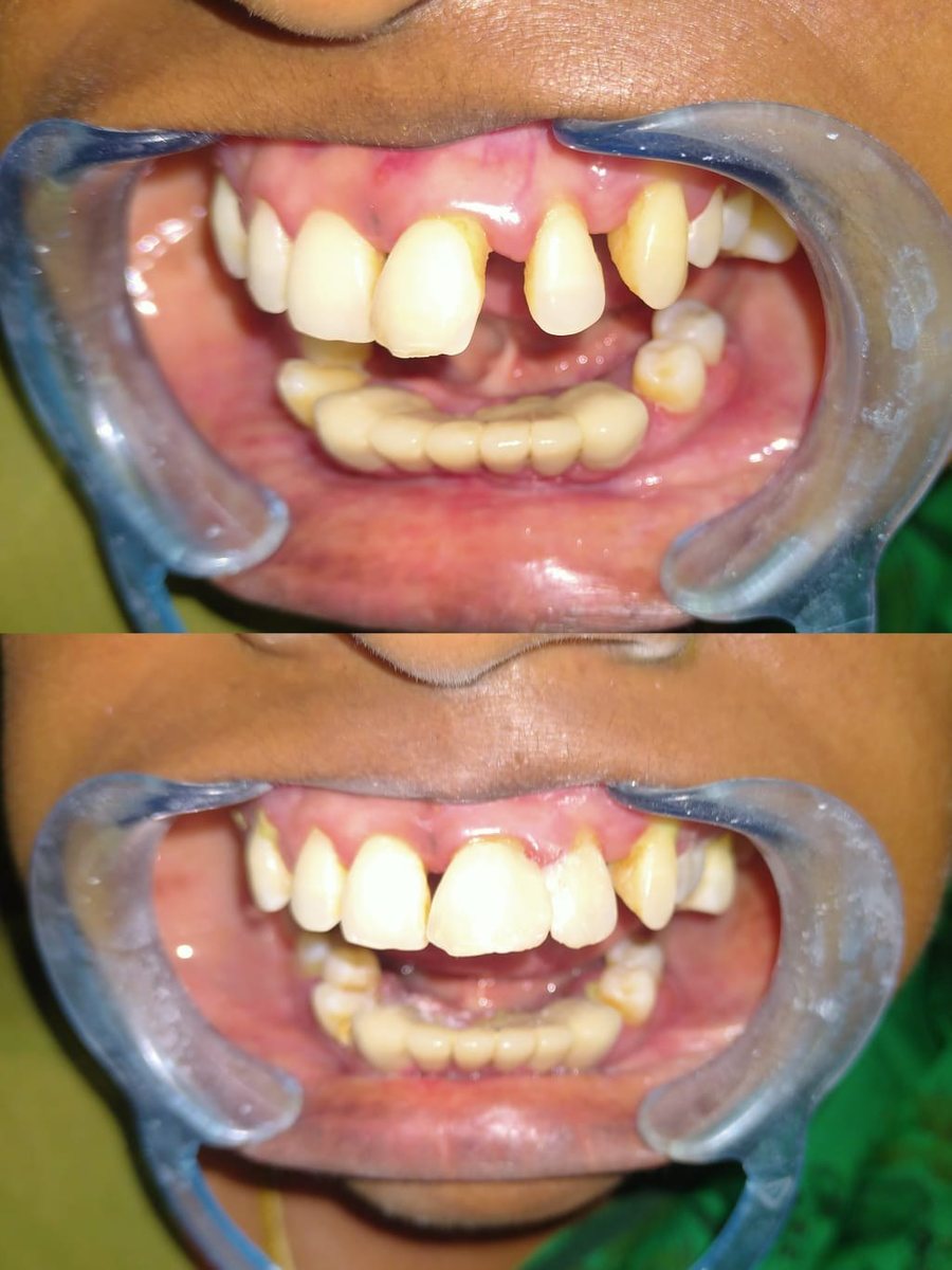 Smile Makeover with Composite Filling — before and after, patient 7