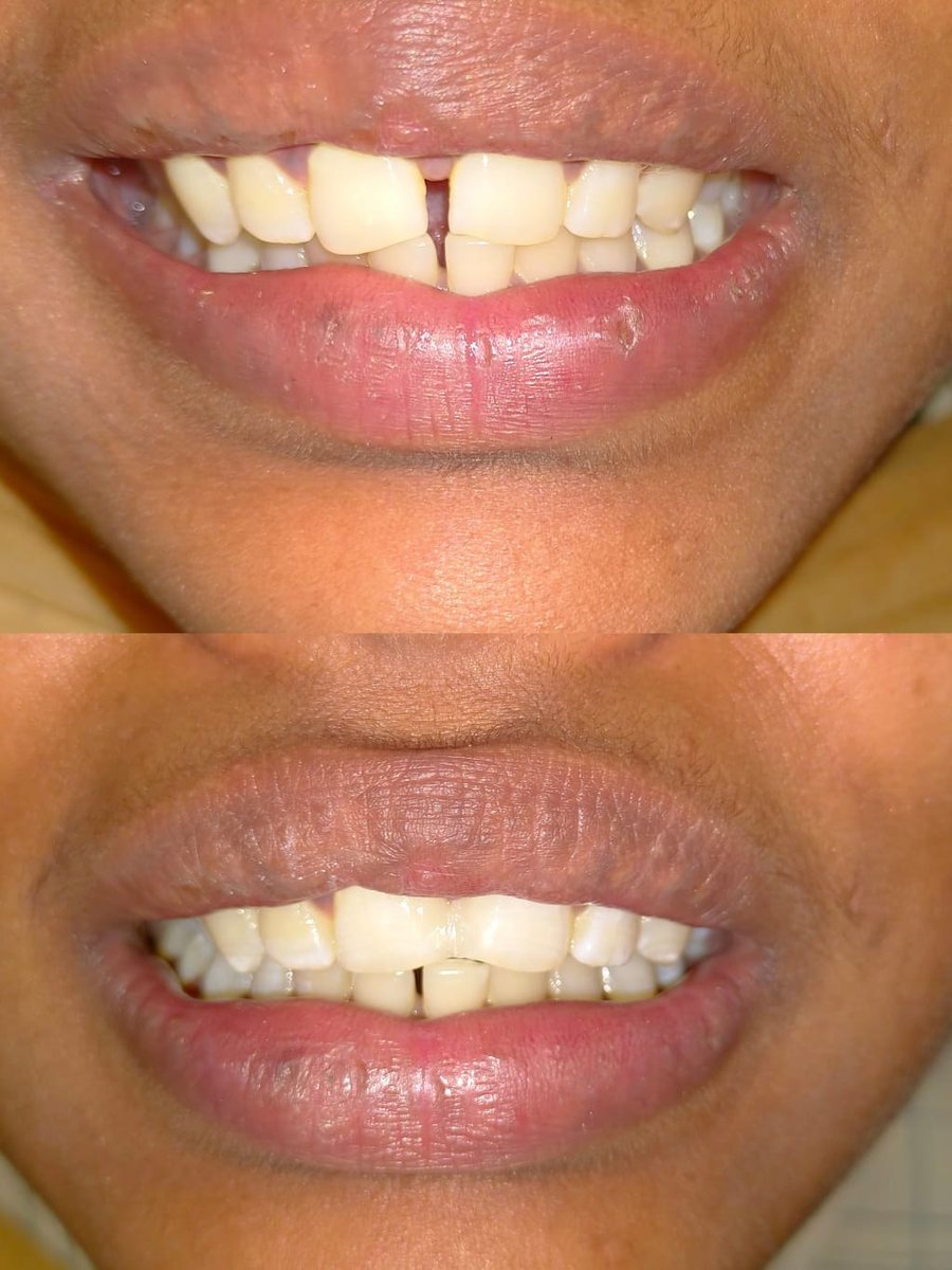 Smile Makeover with Composite Filling — before and after, patient 8
