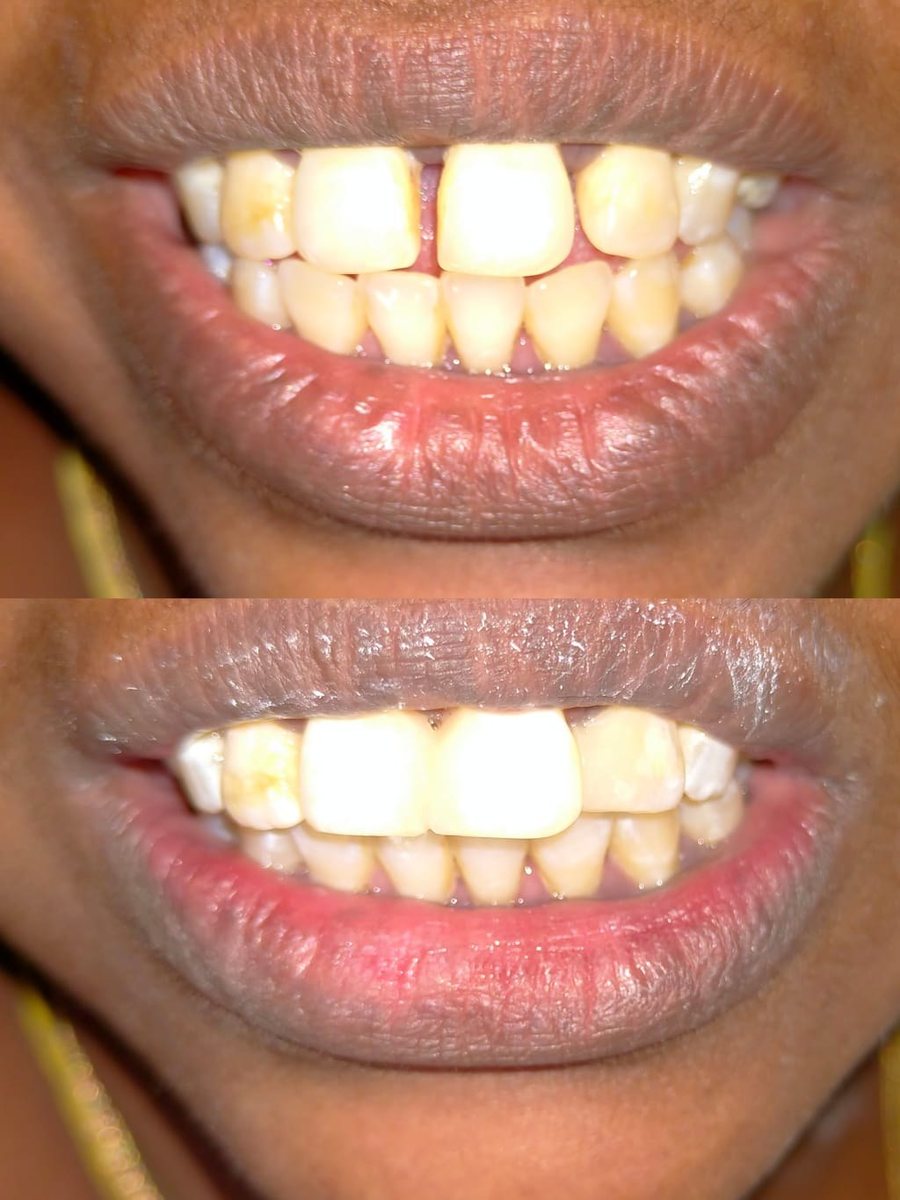 Smile Makeover with Composite Filling — before and after, patient 9