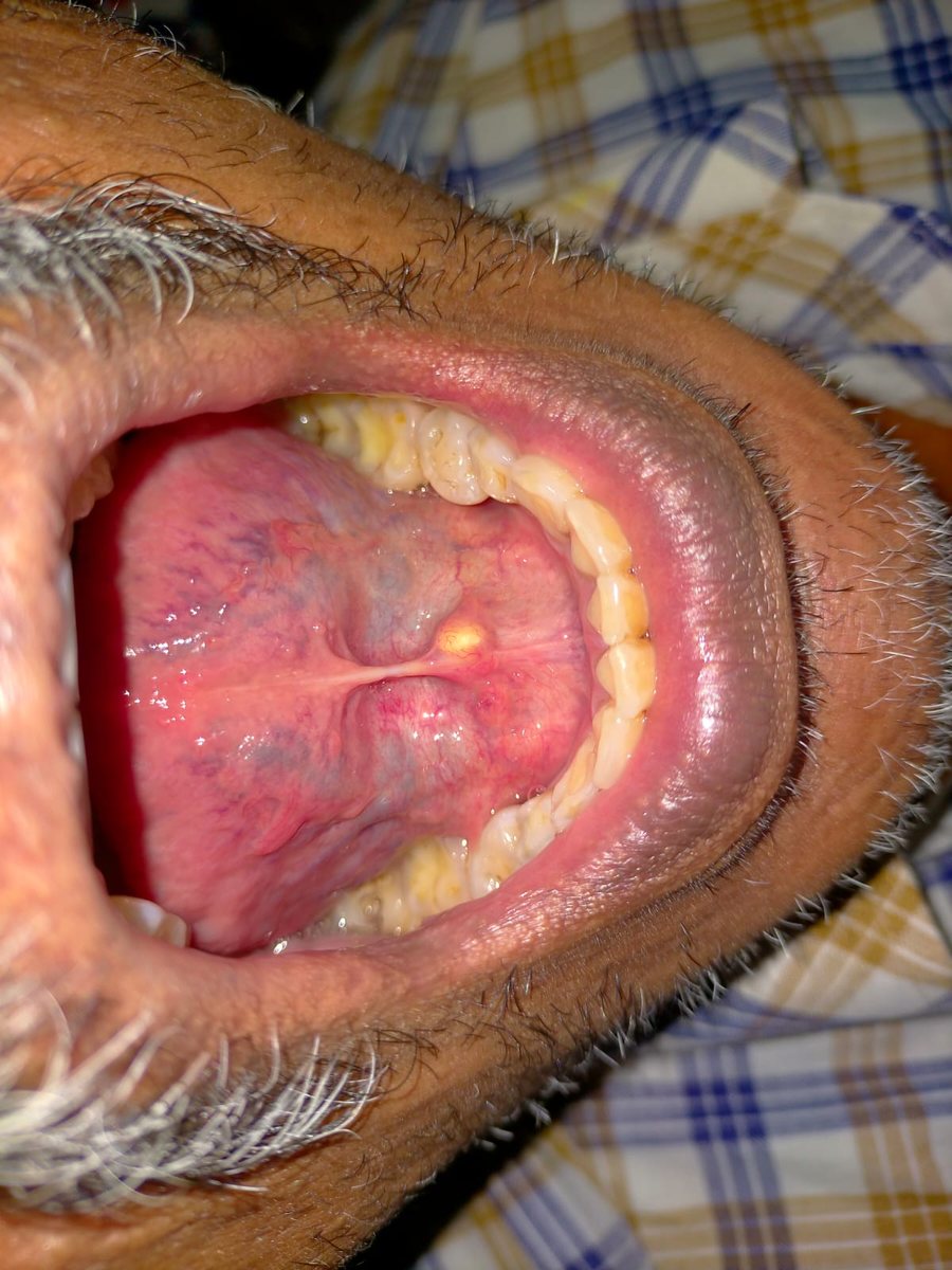 Surgical Removal of Abnormal Growth — case photo 1