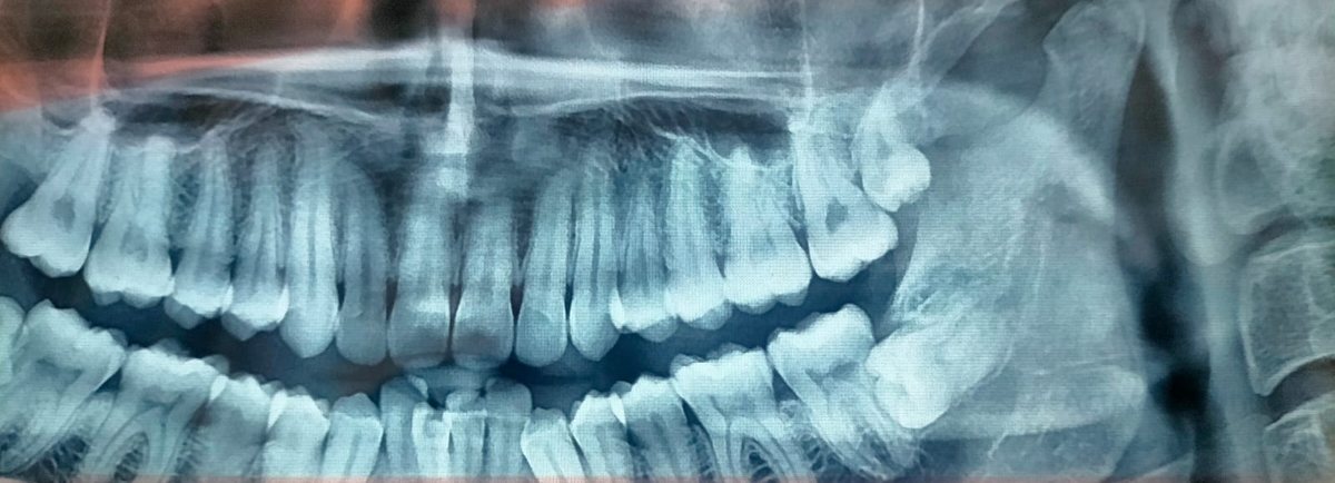 Surgical Removal of Impacted Tooth — case photo 1