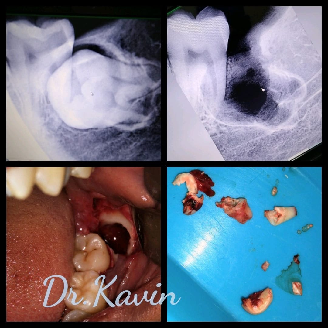 Surgical Removal of Impacted Tooth — case photo 2