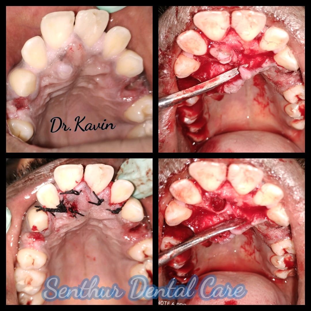 Surgical Removal of Impacted Tooth — case photo 3