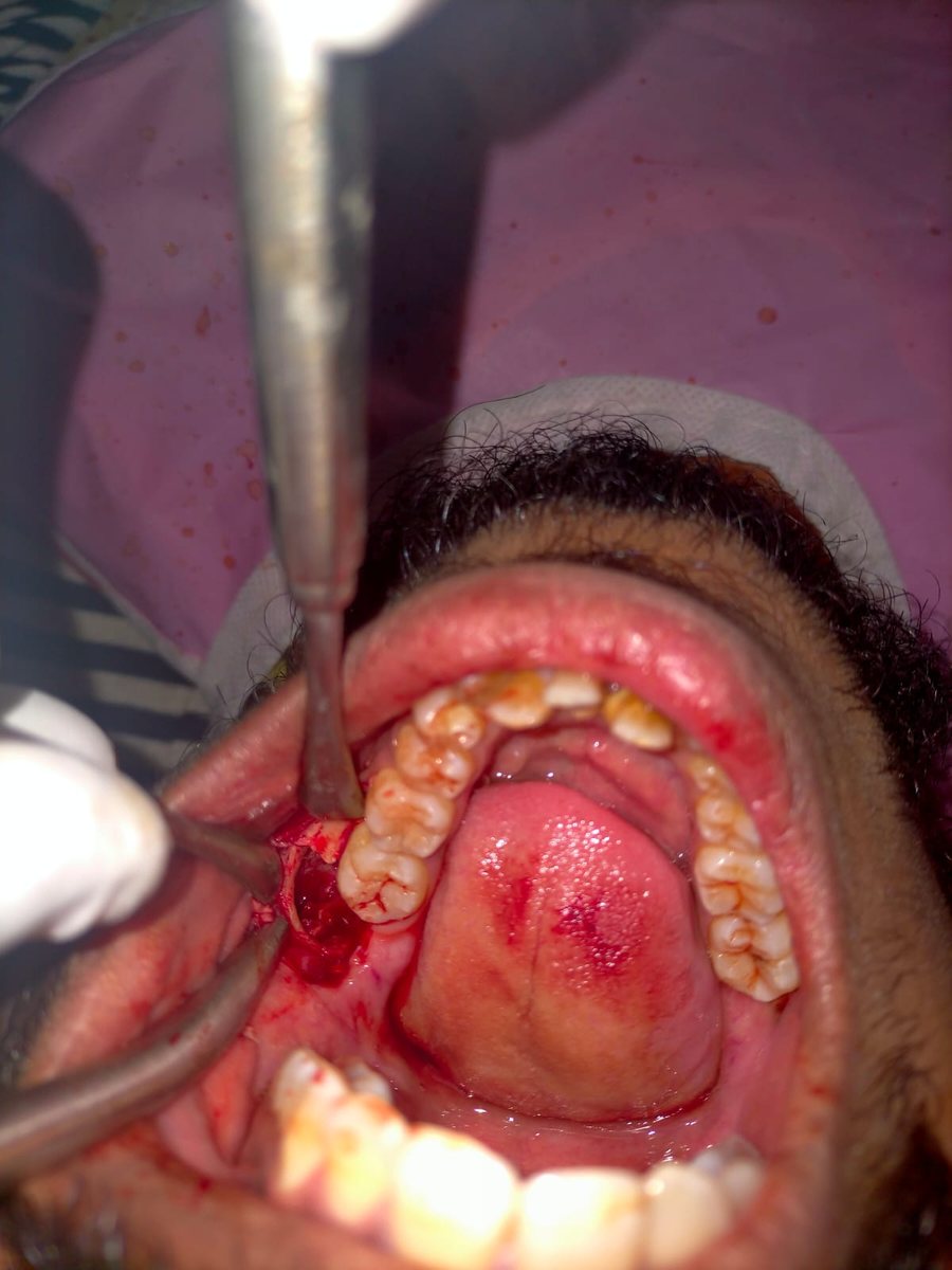 Surgical Removal of Impacted Tooth — case photo 4