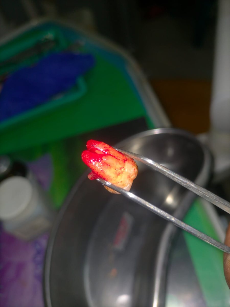 Surgical Removal of Impacted Tooth — case photo 5